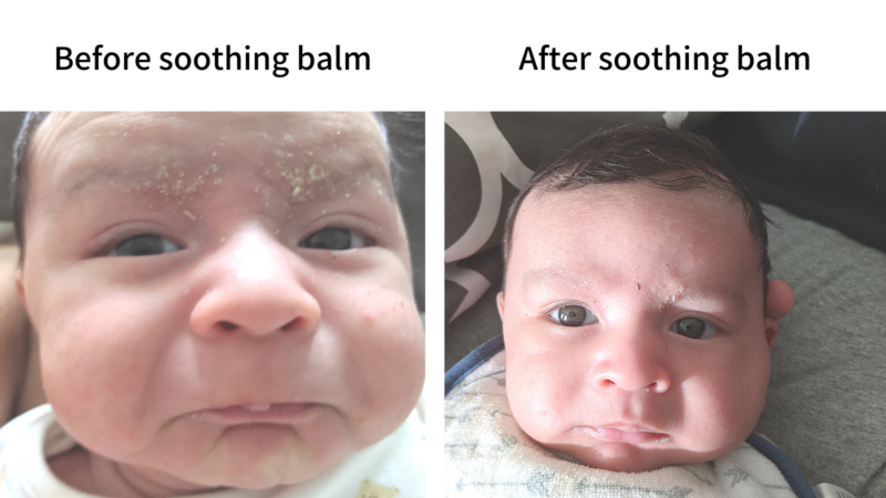 Before and after image showing soothing balm cradle cap treatment